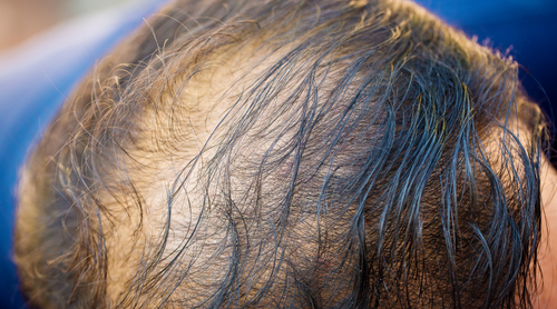 Addressing Thinning Hair: Understanding, Treating, and Preventing Hair Loss