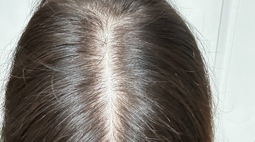 Embracing Change: The Emotional Landscape of Hair Loss for Women