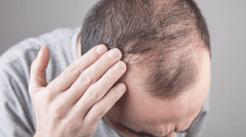 What is Androgenetic Alopecia?